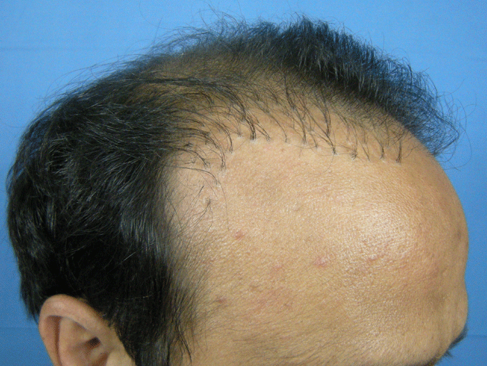 Hair loss forum, learn all about hair loss remedies